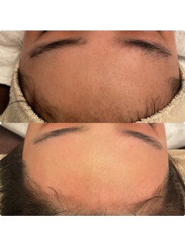 エクラ(eclat)の写真/【その場で顔のムダ毛がなくなる?!】案外見られている顔のうぶ毛…WAX脱毛でごっそり抜き取り♪透明感UP!