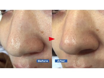 ニュイブラーシュ(nuit blanche)/目立つ毛穴の開きも♪