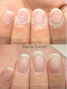 マリーロール 梅田店(Marie Laure)/自爪育成/深爪矯正/ネイルケア