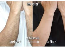 キュー(cue)/【メンズ】「腕脱毛」施術事例