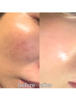 フットミー(foot mii)/韓国で大人気のララピール