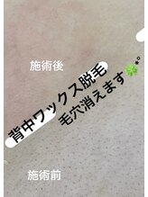 キラン(KIRAN)/背中の毛穴消えます！