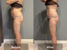 シャイニーシャイニー 金沢店(SHINY/SHINY)/スリムムーヴ痩身症例