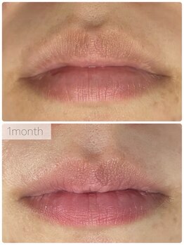 OBS新潟整骨院/ローマピンク途中経過