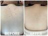 人気No.１◆毛孔性苔癬カウンセリンング【背中】背中ぷつぷつ気になる方