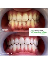 ホワイトニングサロン 名古屋駅店/【ホワイトニング施術例】