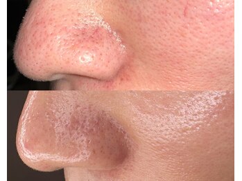 ル シーニュ/毛穴エクストラクション