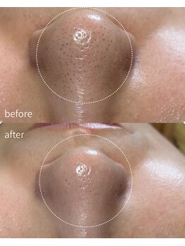 リリーラボ(LILY LAB)/毛穴洗浄症例