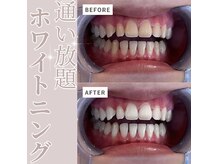 エクシアホワイト 長野店の雰囲気（強力効果のジェル使用◎ホワイトニングデビューの方も大満足☆）