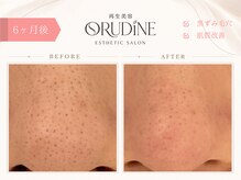 オルディーネ(ORUDiNE)/黒ずみ毛穴改善