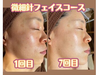 ヌーベルコピーヌ 五井店/微細針フェイスコース人気急上昇
