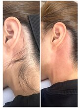 ホワイトワックス 京都四条烏丸(WHITE WAX)/うなじ脱毛