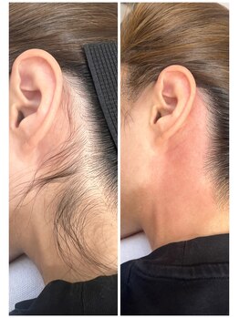 ホワイトワックス 京都四条烏丸(WHITE WAX)/うなじ脱毛