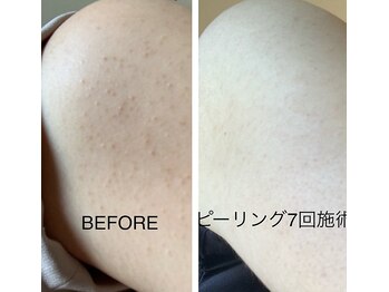 フェローズリンパケア(FELLOWS)/背中or二の腕ピーリング