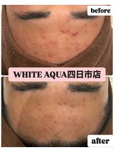 ホワイトアクア 四日市店(WHITE AQUA)/頑固なニキビケアも改善