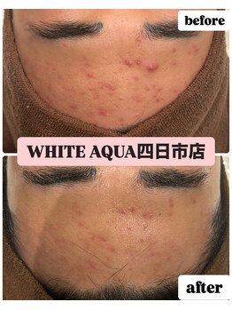 ホワイトアクア 四日市店(WHITE AQUA)/頑固なニキビケアも改善