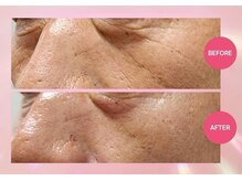 アトワ(A toi)/　プラズマフェイシャル1回