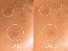 エミルカ 日の出平井店(EMILUCA)/ハーブピーリングでシミケア