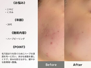 ルディラ医療提携エステ 立川店 毛穴/小顔/ニキビ・シミ・美白・シワ・たるみケア/ハーブピーリング