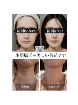 キュープ 北千住店(Qpu)の写真/ほうれい線・たるみにアプローチ!美肌も叶える美顔器コースで、あなたにご褒美を♪