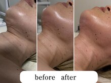 ワンエストサロン(One est.salon)/フェイスライン顎下before after
