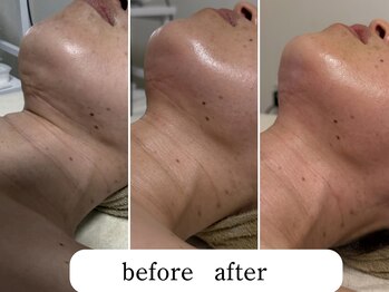 ワンエストサロン(One est.salon)/フェイスライン顎下before after
