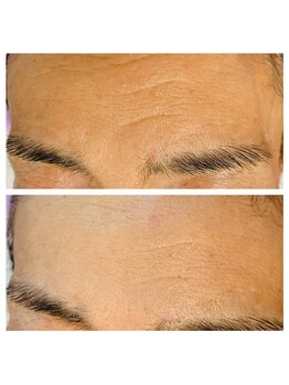 シープ(Sheep)/施術例2(おでこ)