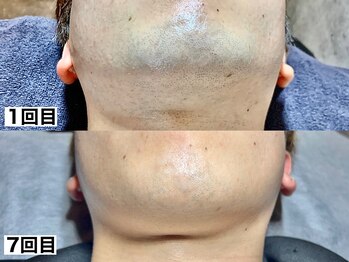 エモーショナル 姫路(Emotional)/ヒゲ脱毛8回目の効果◎