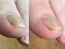 エルユーネイルズ(LUnails)の雰囲気（巻き爪カットで不快感から解放♪）