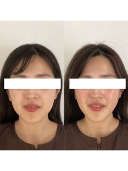 ハリオン 中目黒(HARI-ON)/初回 立体美鍼コース