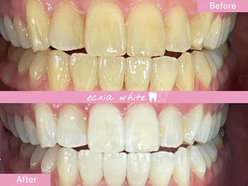 エクシアホワイトニング 札幌中島公園店/ホワイトニングビフォーアフター