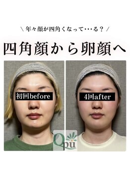 キュープ 群馬吉岡店(Qpu)/小顔矯正モニター募集♪qpu