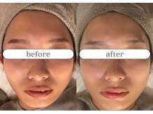 リスタ(RSTA)/【BEFORE/AFTER】