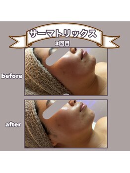 ビーマジック(美magic)/サーマトリックス