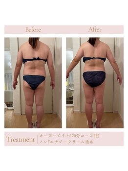 エミル(Emillu)/＊Body_ビフォーアフター