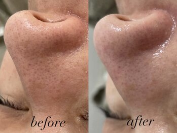 リスポアラボ(LIS PORE.LAB)/1回before after