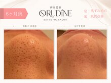 オルディーネ(ORUDiNE)/黒ずみ毛穴改善