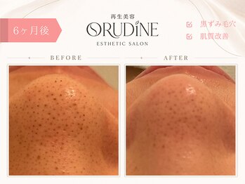 オルディーネ(ORUDiNE)/黒ずみ毛穴改善