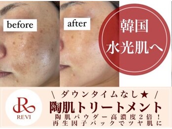 ホワイトアクア 四日市店(WHITE AQUA)/頑固なニキビケアも改善