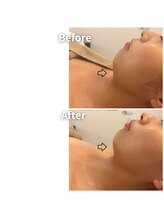 エムボーテ 太田店(M BEAUTE33)/顔筋小顔コルギ