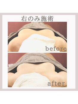 アリサナ(Arisana)/症例写真　バスト　葛西