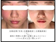 韓国肌管理室 ソア(soa)/【赤ら顔だけでなく歪みも矯正】