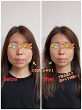 ラウレア(Laulea)/小顔矯正の効果は絶大！