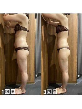 サンナナヨンプラス(374+)/【ハイパーナイフ】before/after