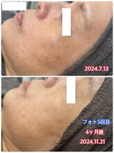 サロンドティアラ(Salon de Tiara)/シミケア(フォト)