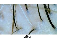 イーズ/リバイタ 梅田本店/【ケース7】30代女性　after