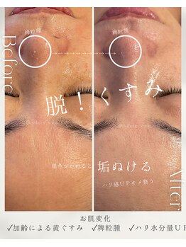 フル(Full)/美肌プログラム