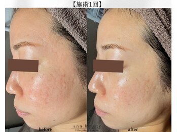 アン ビューティー(ann beauty)/施術1回【症例写真】30代