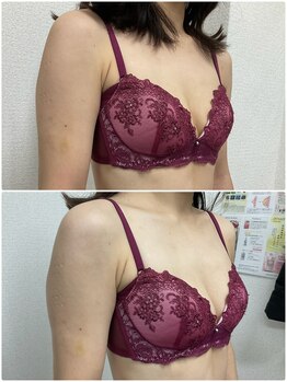 バーディー(BIRDIE)/施術１回/４０代ママ