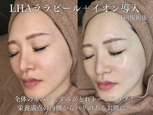 エムラボ 新宿店(M LABO)/LHAララピール＋イオン導入